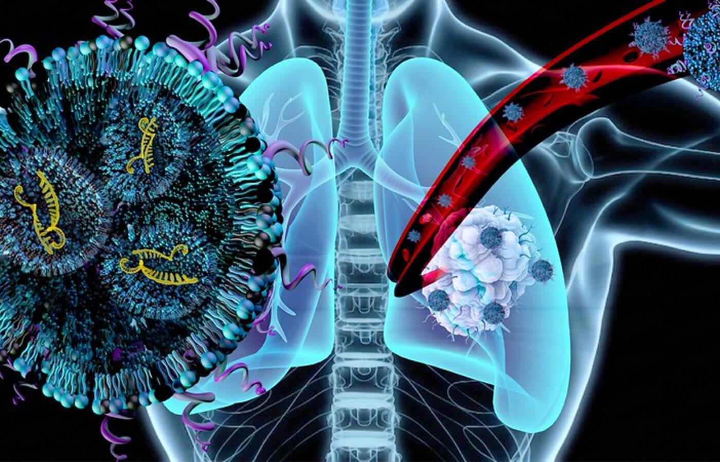This graphic by Parinaz Ghanbari shows depicts treating lung tumors with lipid nanoparticles loaded with follistatin.