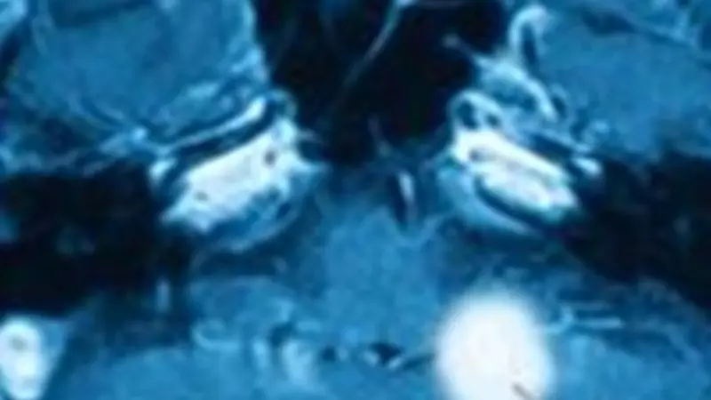 MRI scan