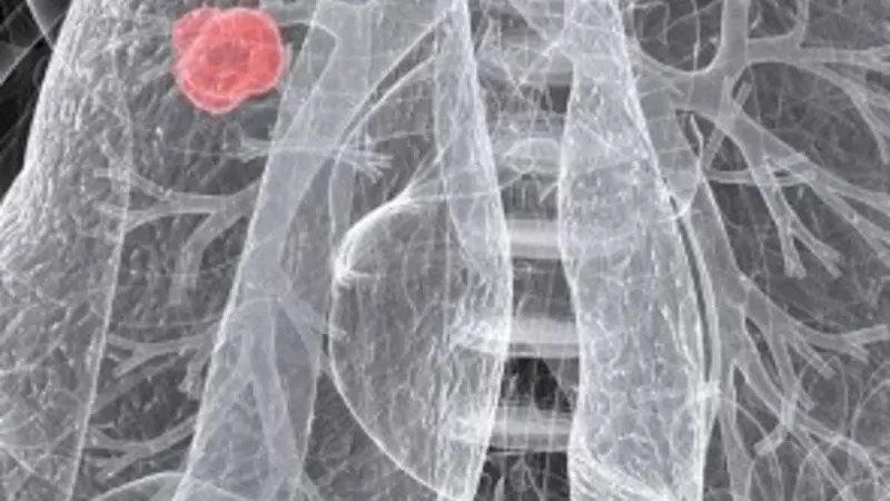 This photo provided by Naturopathic Doctor News and Review shows non-small cell lung cancer in a 54-year-old woman.