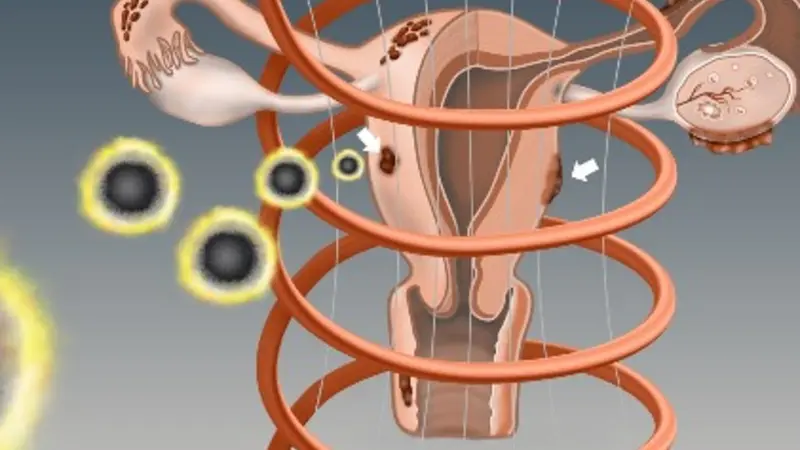 endometriosis treatment