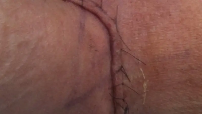 surgical incision