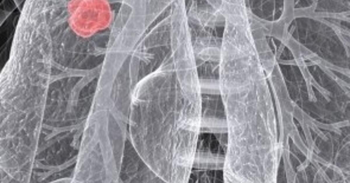 Researchers find way to treat lung cancer and associated muscle wasting at the same time