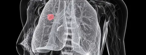 This photo provided by Naturopathic Doctor News and Review shows non-small cell lung cancer in a 54-year-old woman.