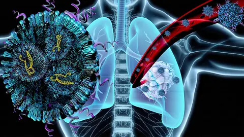 This graphic by Parinaz Ghanbari shows depicts treating lung tumors with lipid nanoparticles loaded with follistatin.