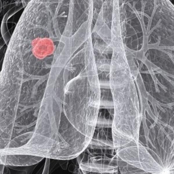This photo provided by Naturopathic Doctor News and Review shows non-small cell lung cancer in a 54-year-old woman.